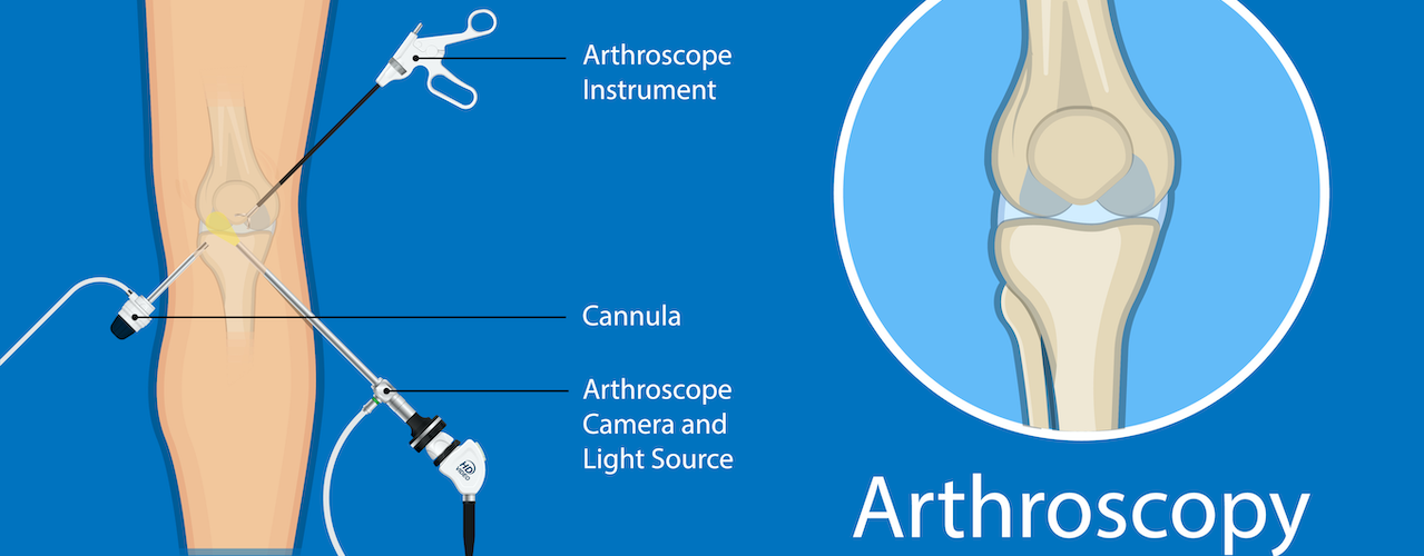 Arthroscopy Diagram