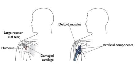 reverse shoulder replacement