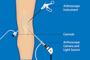 Arthroscopy is one of many options to ease joint pain