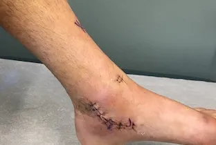 GBO Patient Diary: Appointment 7 - Surgery follow-up — what's this thing look like?