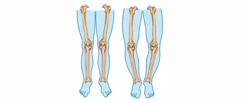 Bowed legs more than a cosmetic issue for this patient