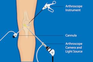 Arthroscopy is one of many options to ease joint pain thumbnail
