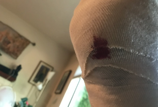 GBO Patient Diary: Appointment 6 - Post-surgery — Now for the hard part thumbnail