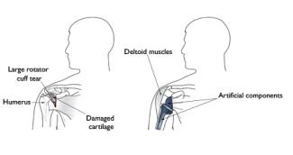 Dr. Dolan undergoes advanced training for reverse shoulder replacement thumbnail