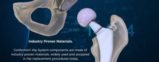 Personalized options for hip replacement patients thumbnail