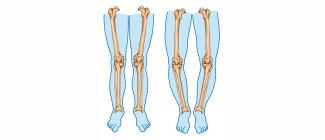 Bowed legs more than a cosmetic issue for this patient thumbnail